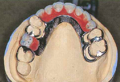金属床義歯（メタルクラスプ）